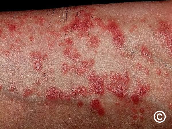 diseases